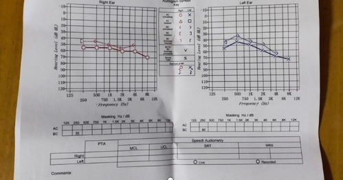 小伙戴耳机睡觉确诊神经性耳聋 小伙戴耳机睡觉确诊神经性耳聋
