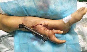 NPC称与游客掰手腕致手臂肱骨断裂 NPC称与游客掰手腕致手臂肱骨断裂
